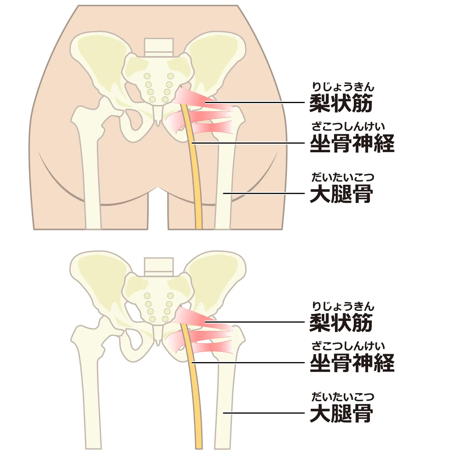 坐骨神経痛とは