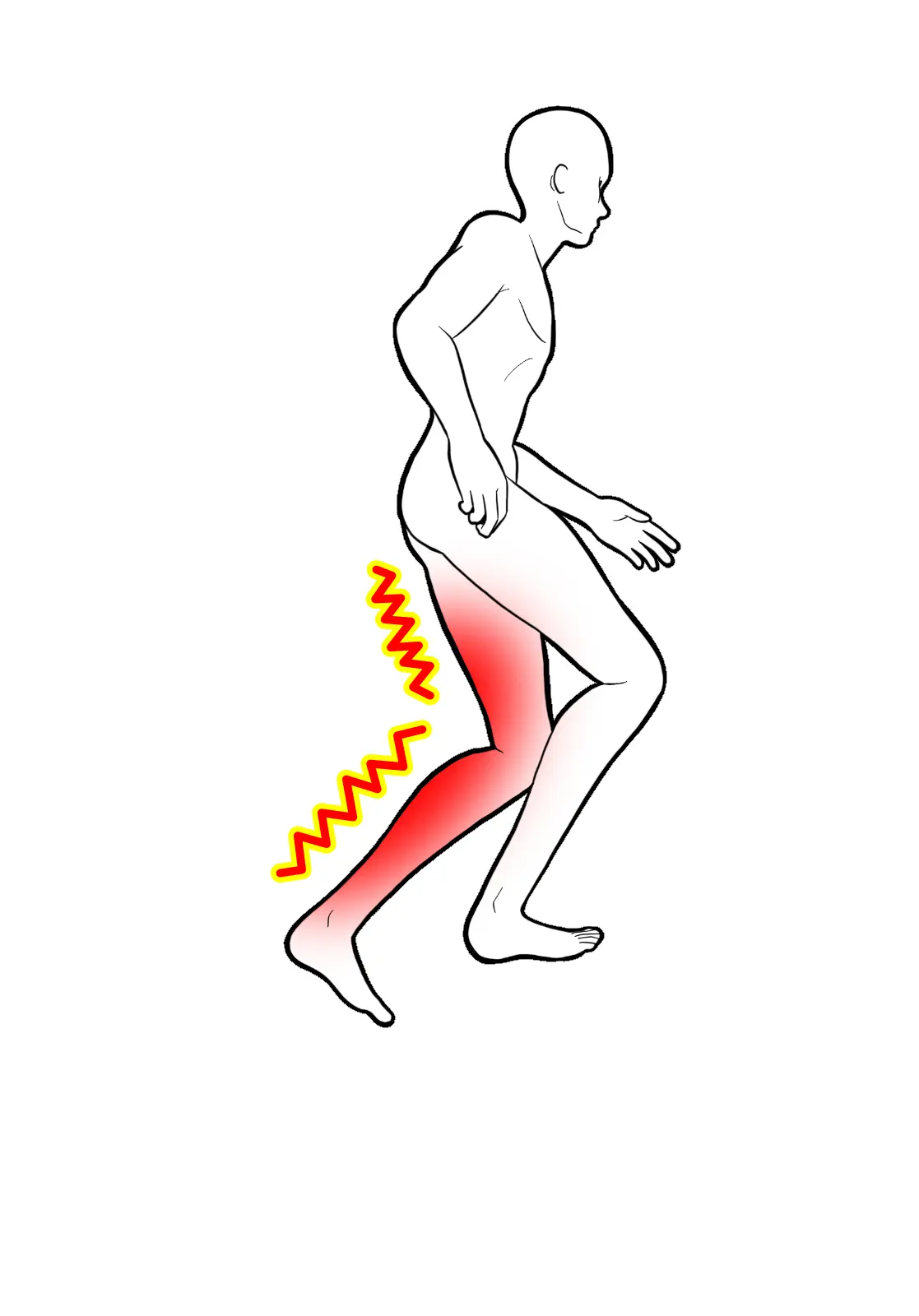 坐骨神経痛の原因